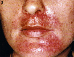 Hautarzt Dr Schnicke Publikationen Gesichtsekzeme