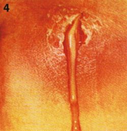 Geplatzt perianalthrombose Blutende Analthrombose