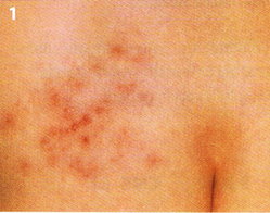 Im intimbereich herpes Herpes genitalis: